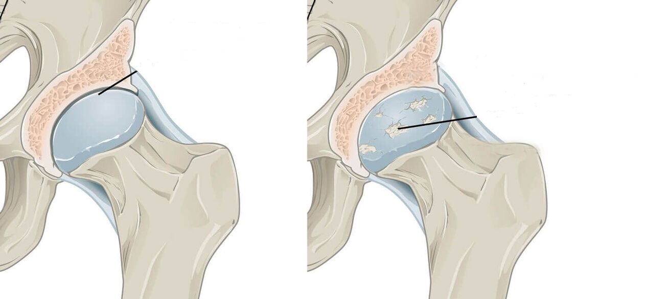 artrosia duen hip artikulazio osasuntsua eta kaltetua